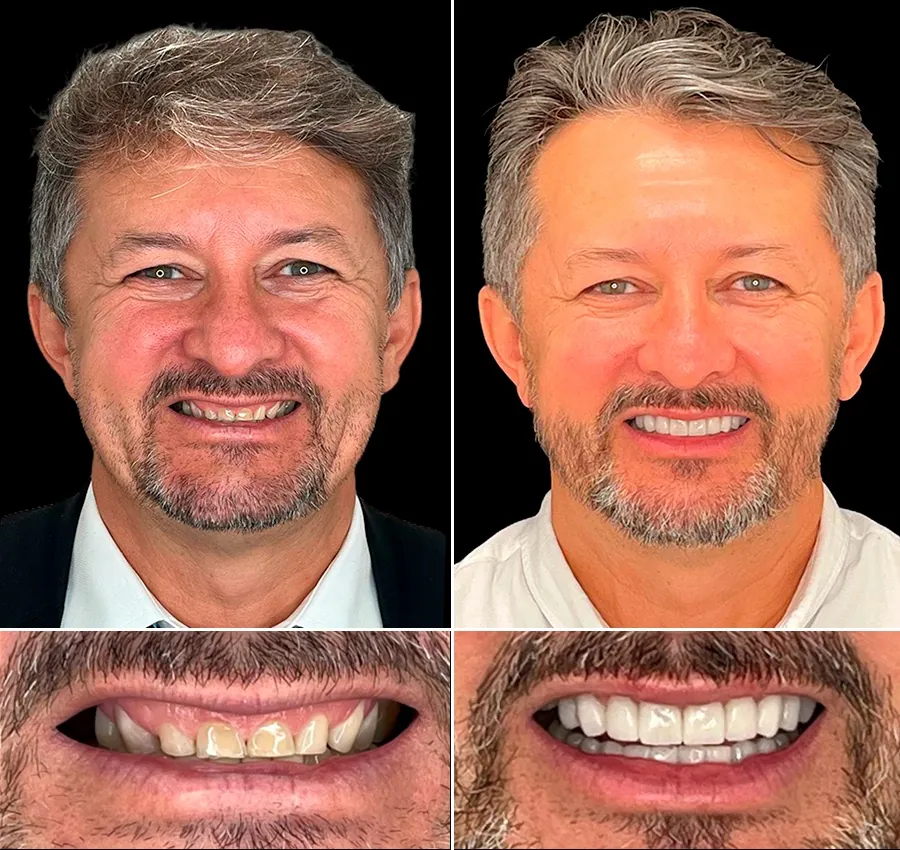 Antes e depois: Tratamento de Bruxismo