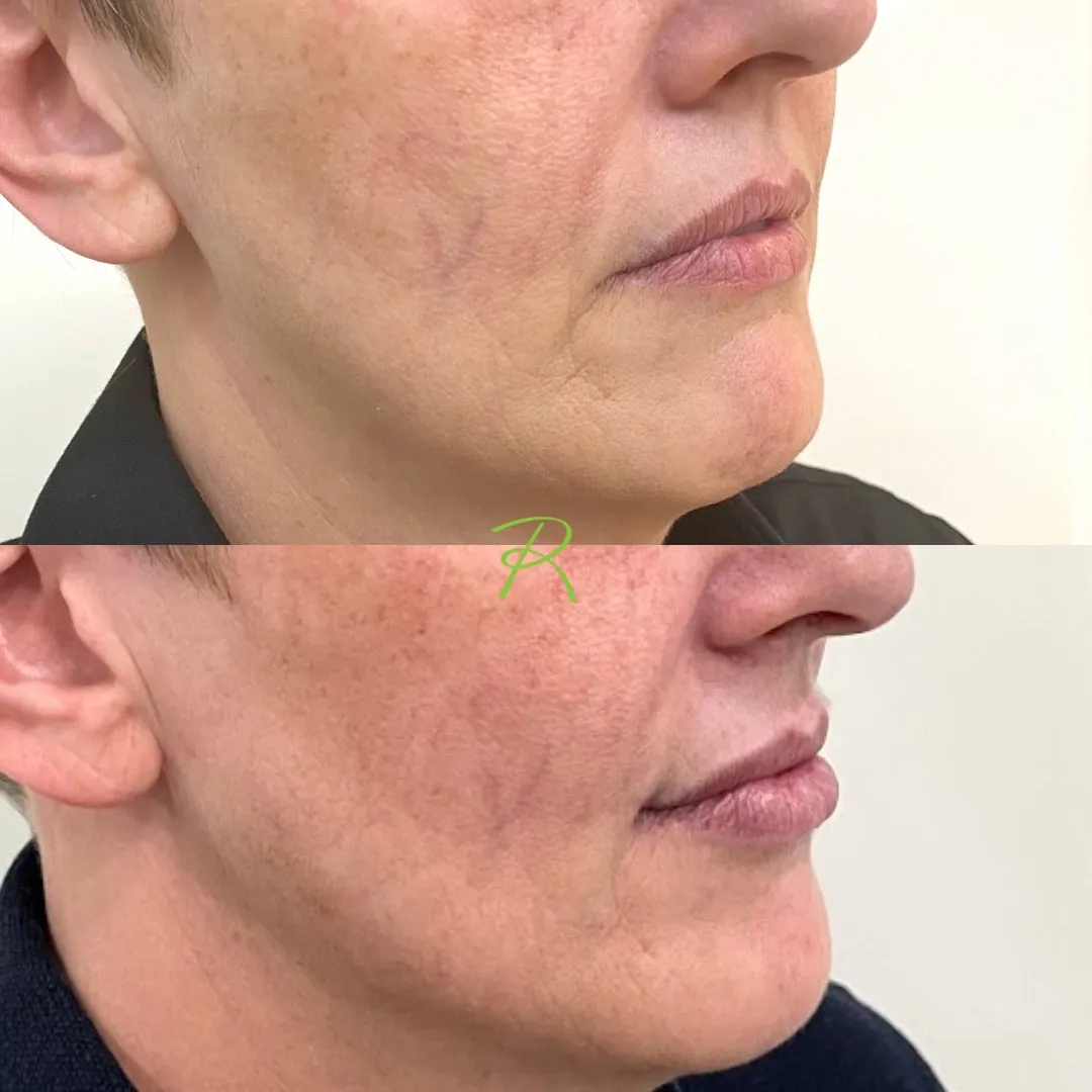 Antes e depois: Lip Lift