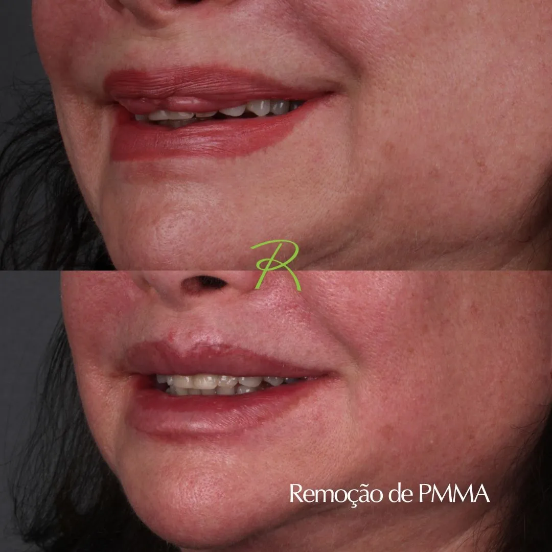 Antes e depois: Remoção de PMMA