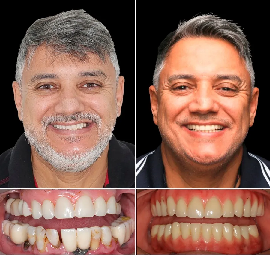 Antes e depois: Prótese Protocolo