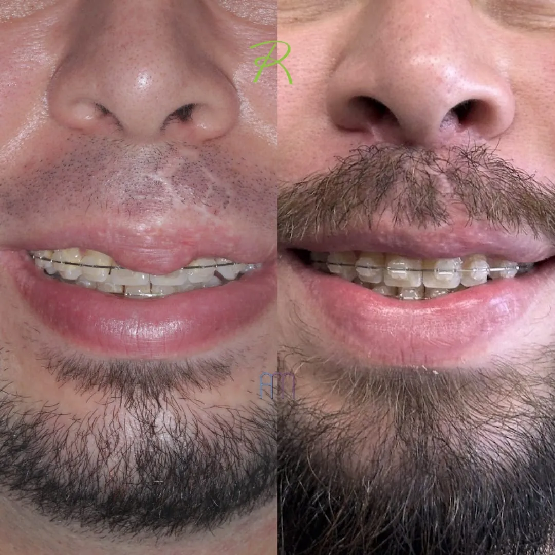 Antes e depois: Queiloplastia Redutora