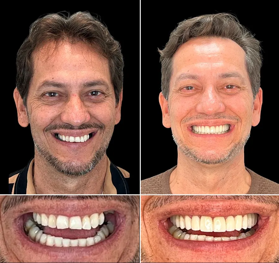 Antes e depois: Reabilitação Oral